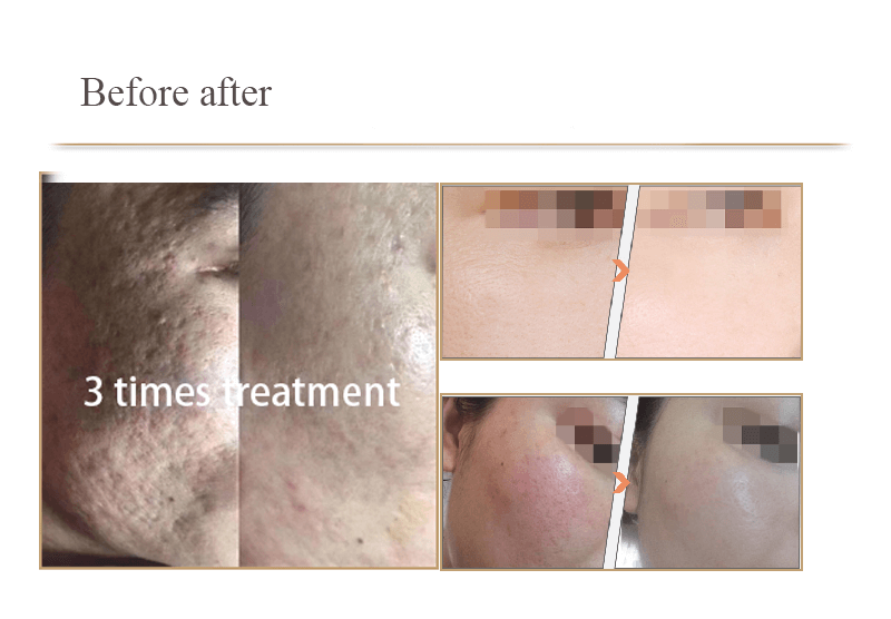 microneedling